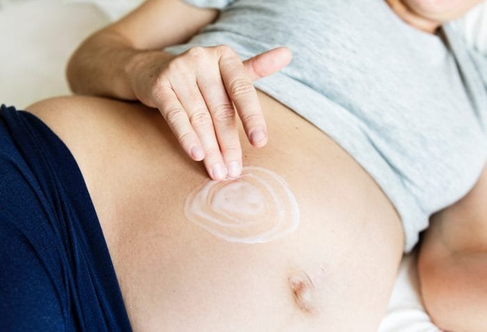 Stretch Marks Singapore Dermatologist