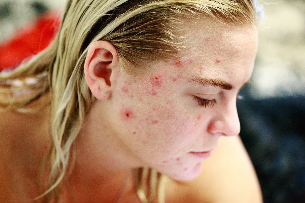 Singapore Dermatologist Cystic Acne Treatments