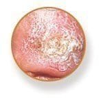This image has an empty alt attribute; its file name is Squamous-cell.jpg