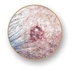 This image has an empty alt attribute; its file name is types-of-skin-cancer-basal-cell-carcinoma.jpg