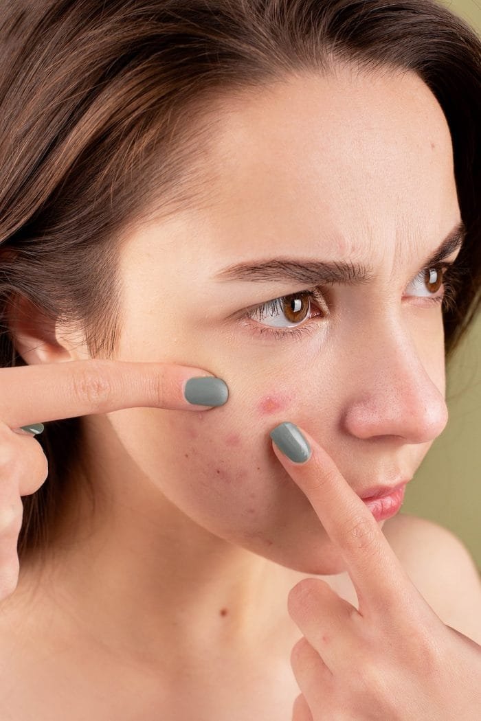 influence of hormones on teenage acne