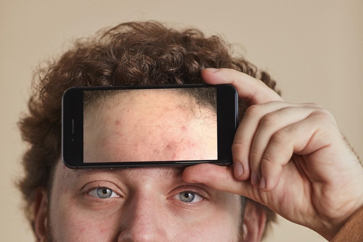 Teenage acne appear on the forehead and T-zone