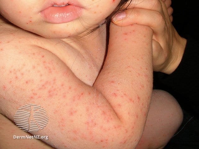Viral Exanthem in Babies